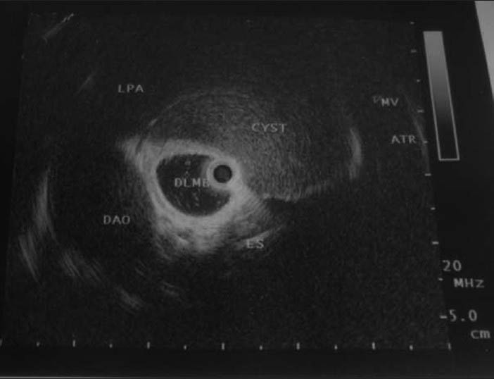 18-year-old male with progressive dyspnea on exertion and dry cough diagnosed with bronchogenic cyst. Endobronchial ultrasound demonstrates a hypoechoic homogeneous lesion compressing the left main stem bronchus suspicious of a cystic mass with surrounding anatomical structures. DLMB: Distal left main bronchus, DAO: Descending aorta, LPA: left pulmonary artery, ATR: Atrium, MV: Mitral valve.