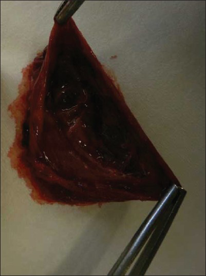 18-year-old male with progressive dyspnea on exertion and dry cough diagnosed with bronchogenic cyst. Photography the surgically removed mass shows the resected thin-walled and unilocular cyst measuring a maximum of 4.5 cm × 3.5 cm × 2.5 cm and containing mostly mucous brownish fluid.