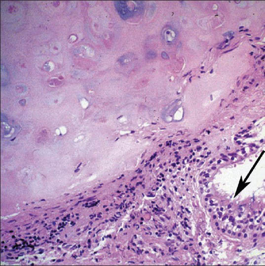 18-year-old male with progressive dyspnea on exertion and dry cough diagnosed with bronchogenic cyst. Microscopic examination of the mass (Hematoxylin and Eosin, ×50) shows a portion of the cyst wall with respiratory epithelium (black arrow) that overlies fibrous tissue and cartilage.
