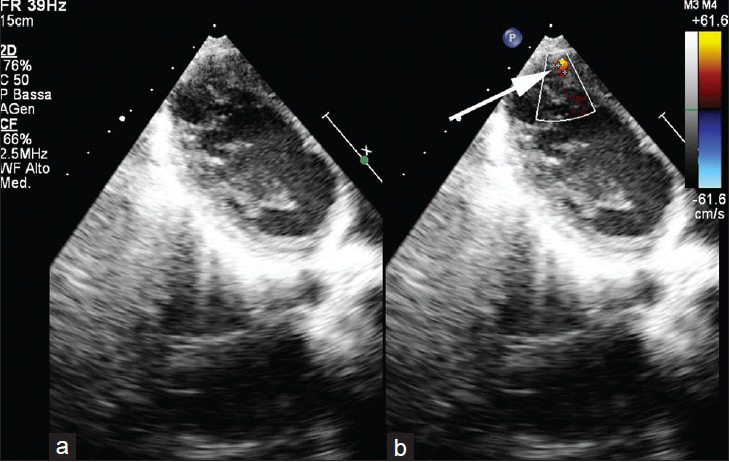 12-year-old male with a small muscular apical ventricular septal defect ventricular septal defect. Ecocardiography in (a) a long-axis four-chamber plane b) color Doppler image shows the presence of a small apical muscular ventricular septal defect (arrow in b).