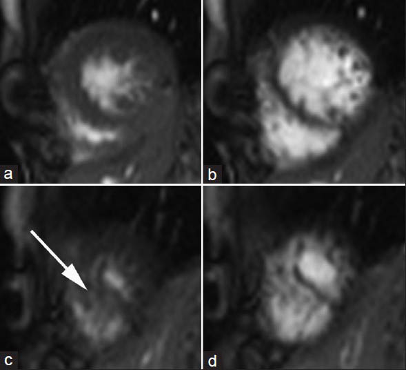 12-year-old male with a small muscular apical ventricular septal defect. Cine true-fast imaging with steady-state precession short-axis in the apical portions in (a and c) systole and (b and d) diastole show hypertrabeculation of the myocardium of the left ventricle (arrow).