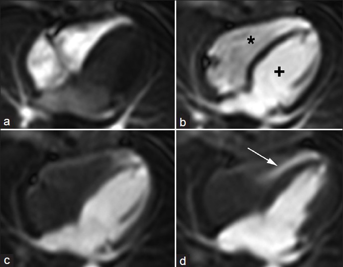 12-year-old male with a small muscular apical ventricular septal defect (VSD). First Pass Perfusion long-axis four-chambers shows the passage of the contrast material through a) the right chambers (*), then b) through the left (+) chambers. (c, d), When the right chambers are empty and clear the image shows the passage of the contrast material (arrow) from left to right ventricle through the small apical muscular ventricular septal defect