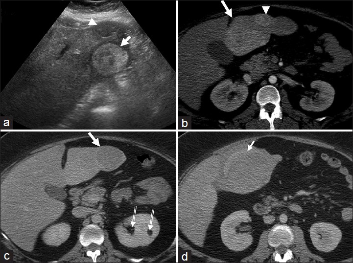 Multiple hepatic adenomas. (a) Transverse ultrasound image of the left lobe of the liver shows a heterogeneous, predominantly hyperechoic lesion (arrow) with no overlying liver parenchyma. Another hypoechoic lesion (arrow head) is seen anteriorly. (b and c) Axial contrast-enhanced computed tomography (CT) sections of the liver in (b) hepatic arterial and (c) portal venous phases reveal hypervascular lesions (white arrows and arrowhead) in the left lobe of the liver which are isodense on the venous phase. Note the absence of capsule and peripheral liver parenchyma. Small incidental left renal angiomyolipomas (double lined arrows in c) are also noted. A diagnosis of multiple hepatic adenomas was made. (d) Axial contrast-enhanced CT image demonstrates rupture of the hepatic adenoma (arrow) with perihepatic hematoma. The patient was initially managed with hepatic artery embolization and the lesions were subsequently excised surgically with histopathology confirming adenomas.