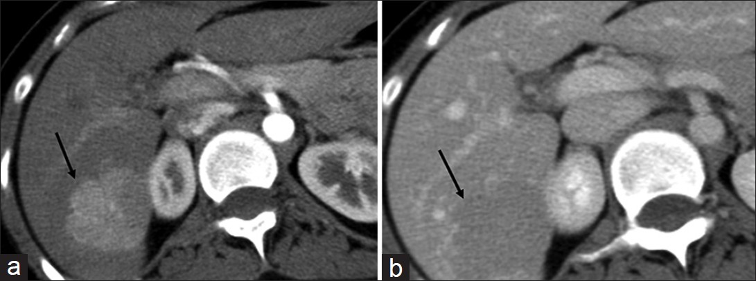 Focal nodular hyperplasia. (a and b) Axial contrast-enhanced computed tomography sections of the liver in (a) hepatic arterial and (b) portal venous phase demonstrate a focal lesion (arrow) in the right lobe which is hypervascular in the arterial phase and becomes iso- to hypo-dense to the liver parenchyma in the venous phase.