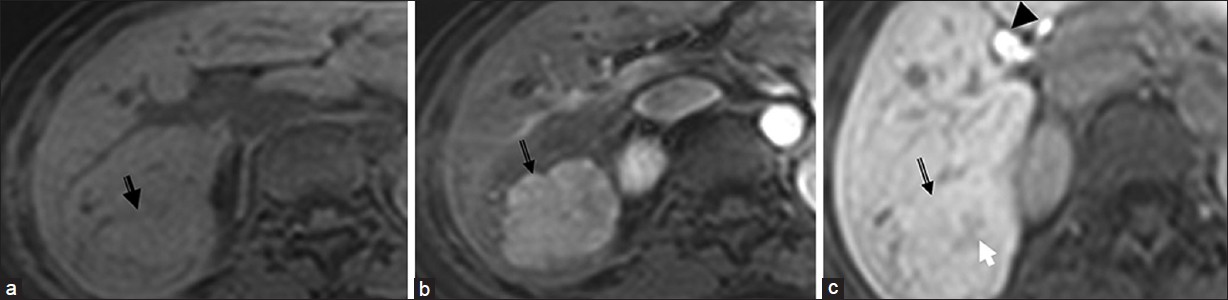 Focal nodular hyperplasia. (a, b and c) Dynamic contrast-enhanced magnetic resonance imaging with Gadoxetate disodium (Gd-EOB-DTPA) on T1-weighted images (a) Arrow emonstrates an isointense lesion. (b) in arterial phase it is hypervascular and c) on 20 min delayed phase retains contrast. Note the central scar (white arrow) and contrast excretion in the biliary tree (arrow head) on the delayed image (c).