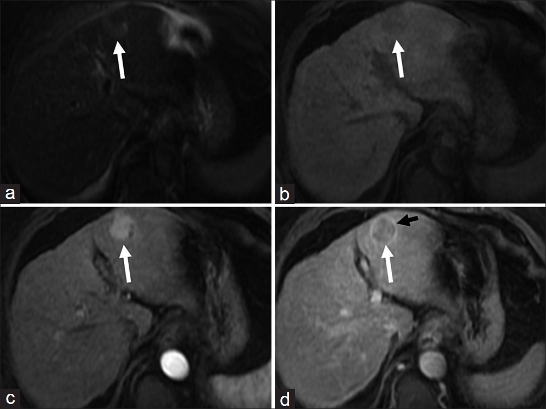 Hepatocellular carcinoma (a) Axial T2-weighted magnetic resonance (MR) image demonstrates a hyperintense lesion (arrow) in the segment III of the liver. Axial fat-suppressed (b) pre and post-gadolinium T1-weighted MR images in the (c) arterial and (d) delayed phases reveal the lesion to be faintly hypointense and hypervascular with washout in the delayed phase. Note the enhancing peripheral tumor capsule on delayed images (black arrow in d).