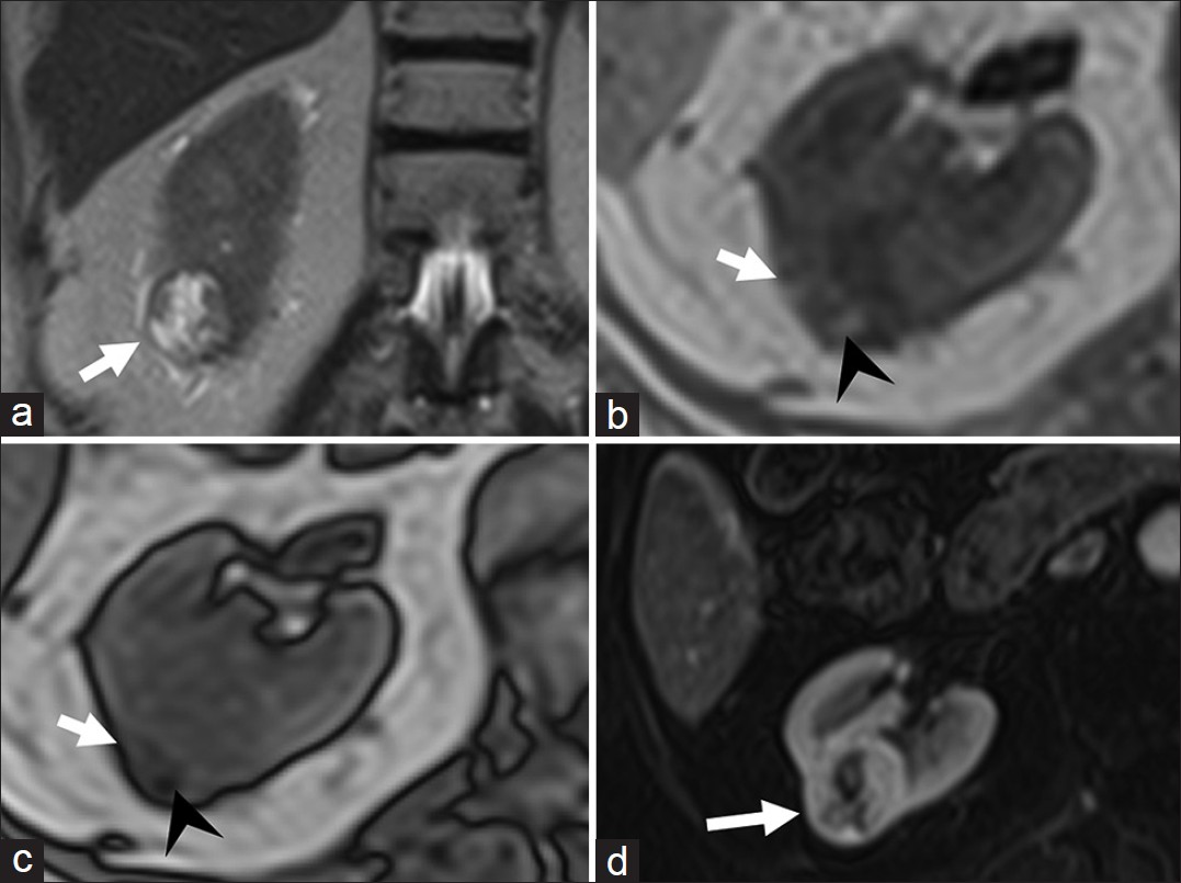 Clear cell variant of renal cell carcinoma. (a) Coronal T2-weighted magnetic resonance (MR) image demonstrates a hyperintense lesion (arrow) in the lower pole of right kidney. Axial (b) in- and (c) out-of-phase T1-weighted MR images demonstrate areas of drop in signal (arrow head) in the lesion suggestive of intra-lesional fat. (d) Axial fat-suppressed post-gadolinium T1-weighted MR image in the arterial phase reveals the lesion to be hypervascular. Histopathology confirmed clear cell variant of renal cell carcinoma.