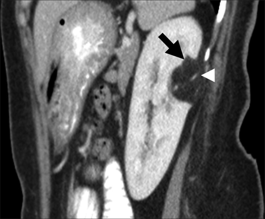 Renal angiomyolipoma. Sagittal reformatted image of contrast enhanced computed tomography shows a fat attenuation lesion (black arrow) in the posterior interpolar region of the left kidney. Note the prominent vascular component (arrow head) in the lesion.