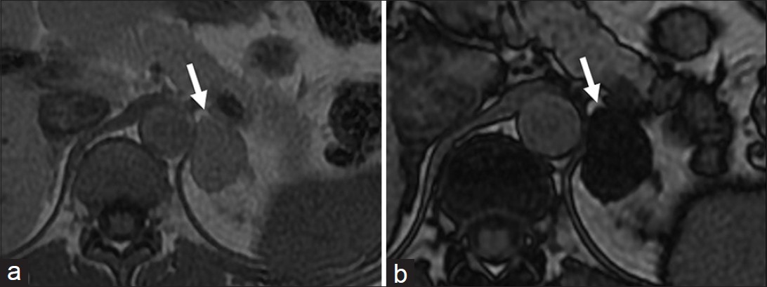 Adrenal Adenoma. Axial (a) in- and (b) out-of-phase T1-weighted magnetic resonance images demonstrate (a) left adrenal lesion (arrow) which shows significant drop of signal in the out-of-phase image (b) suggestive of lipid-rich adenoma.