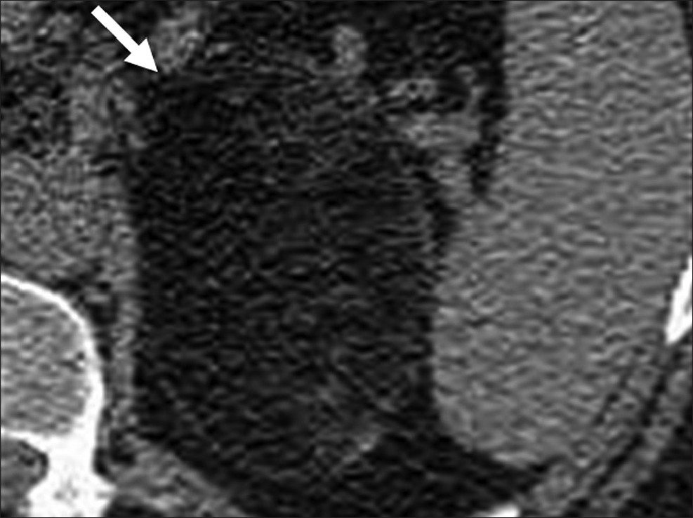 Adrenal myelolipoma. Axial unenhanced computed tomography shows a well-defined lesion with macroscopic fat (arrow) in the left suprarenal region.