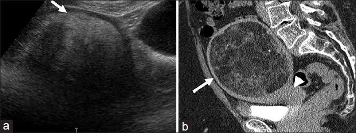 Uterine lipoleiomyoma: (a) Sagittal ultra sound image through the pelvis demonstrates a heterogeneous, predominantly hyperechoic lesion (arrow). (b) Sagittal reformatted computed tomography image of the pelvis reveals the mass to be arising from the uterus (arrow head) and contain macroscopic fat (arrow).