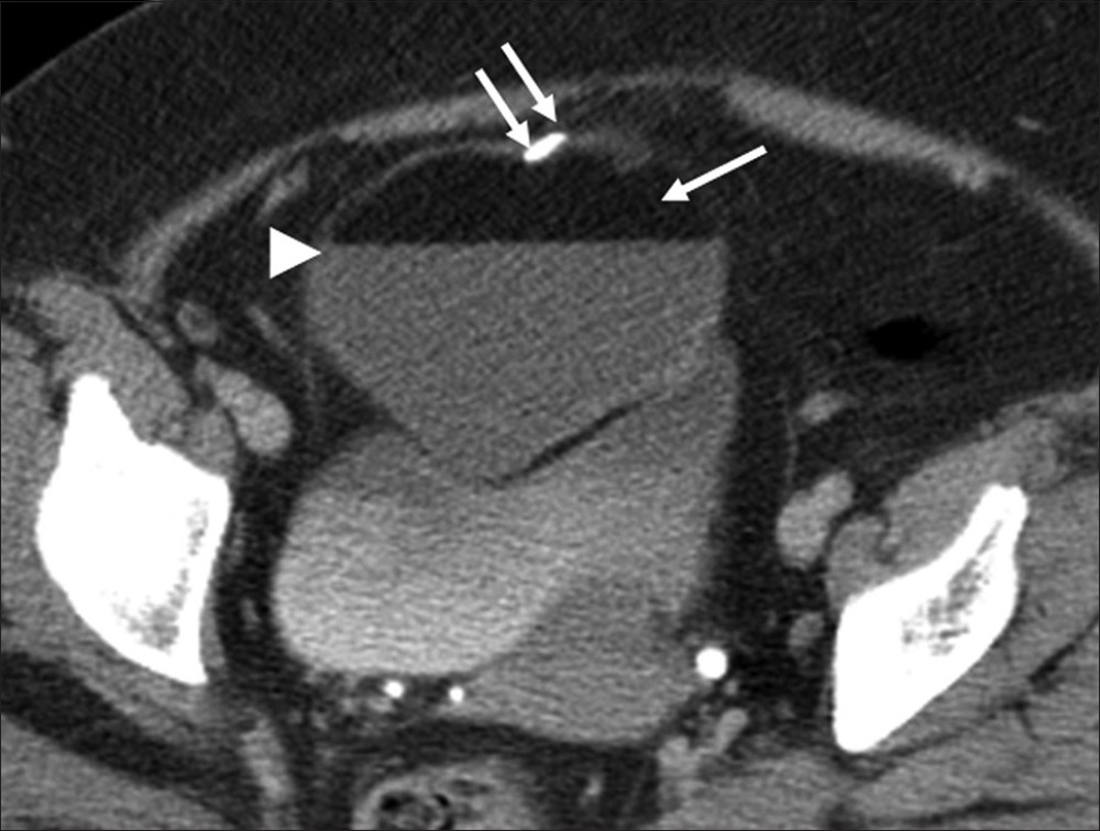 Ovarian teratoma. Axial contrast-enhanced computed tomography image of the pelvis reveals a well-defined adnexal lesion with fat (single arrow), fat-fluid level (arrow head) and calcification (double arrow).