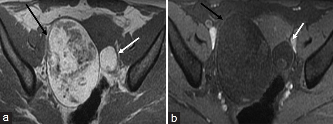 Ovarian teratoma. Axial non-fat-suppressed (a) pre- and (b) fat-suppressed post-gadolinium T1-weighted magnetic resonance images demonstrate high signal intensity areas in the lesion (a) on non-fat-suppressed image which are suppressed on the fat-suppressed image suggestive of macroscopic fat in the lesion (black arrow). Note the presence of a smaller teratoma in the left ovary which shows similar signal characteristics (white arrow).