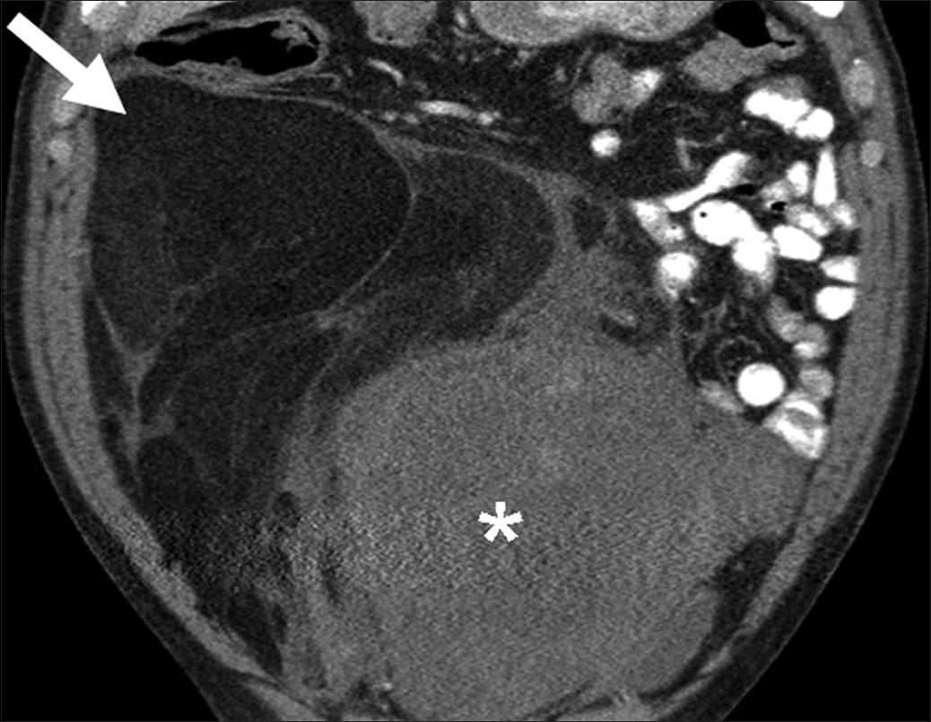 Retroperitoneal liposarcoma. Coronal reformatted image of contrastenhanced computed tomography demonstrates a large retroperitoneal mass with areas of fatty attenuation (single arrow) and heterogeneous soft tissue component (asterisk).