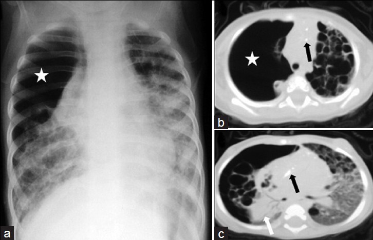 Langerhans cell histiocytosis in a 10-month-old infant. (a) Chest radiograph shows a large pneumothorax (*) associated with collapse of the right lung and bilateral ring and linear opacities, and ground glass attenuation. CT scans (b) (mediastinal window) and (c) (lung window) show bilateral numerous thick- and thin-walled lung cysts. There is evidence of diffuse ground glass attenuation on the left lung and multiple punctate calcifications (black arrows) within the mediastinum. Note the large pneumothorax (*) on the right lung with almost complete collapse of the right lung (white arrow).