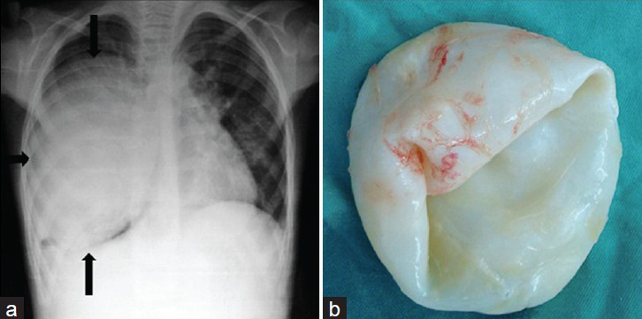 Lung hydatid cyst in a 10-year-old boy. a) Chest radiograph shows a well circumscribed, masslike lesion (black arrow) on the right lung and displacement of the mediastinum to the left. b) Photograph of the specimen.