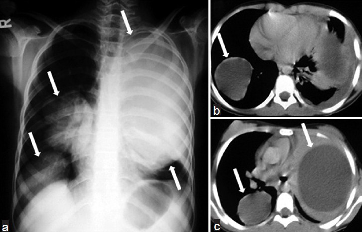 Multiple lung HCs in a 10-year-old girl. a) Chest radiograph shows multiple well-defined masses of increased opacity in both lung fields (white arrows). b-c) CT scans reveal intact hydatid cysts as unilocular water-density lesions (white arrows).