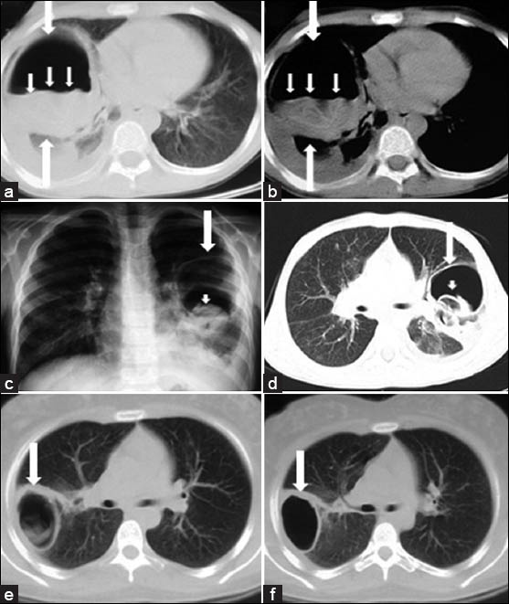 Radiologic signs of ruptured lung HC in children. a-b) CT scans show detached endocystic membranes (short arrows) floating within the fluid content of a large cyst (water-lily sign) (white arrows). c) Chest radiograph and d) CT scan show a ruptured hydatid cyst (white arrows) and the collapsed parasitic membranes in the dependent part of the pericystic cavity (sign of the rising sun) (arrowhead). e) CT scan shows a ruptured hydatid cyst and (f) follow-up CT scan obtained two months after the initial CT scan shows that the cyst contents are expectorated completely (empty cyst sign) (white arrow).