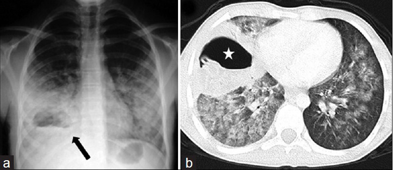 Hydatid abscess in a 13-year-old boy. a) Chest radiograph shows a ruptured hydatid cyst (arrow) obscured by surrounding pneumonitis and an air-fluid level mimicking abscess. Note that bacterial infection may become widespread throughout the left lung. b) CT scan (lung window) reveals the hydatid abscess (star) with an air-fluid level in the right lung, but retains no pathognomonic features of hydatid disease. Radiologic findings may suggest the hydatid origin of the abscess in the proper clinic setting.