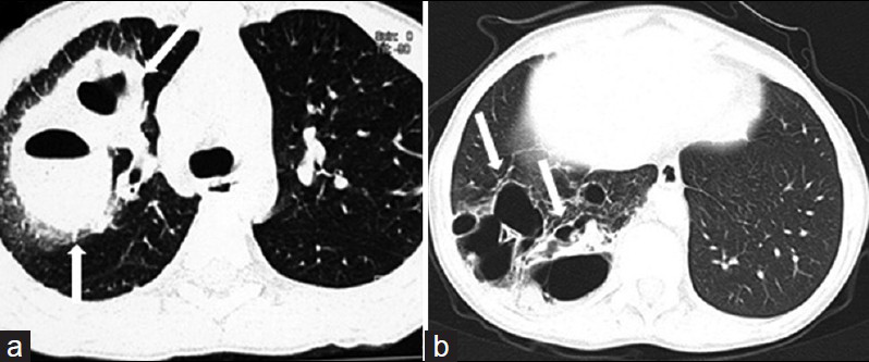 Pneumatoceles developing in 13-year-old boy with staphylococcal pneumonia. a) CT scan shows thick-walled pneumatoceles (white arrows) in the early phase of pneumonia in the right upper lobe. b) In another patient, follow-up CT scan obtained 20 months after initial infection shows numerous residual pneumatoceles (white arrows) in the right lower lobe.