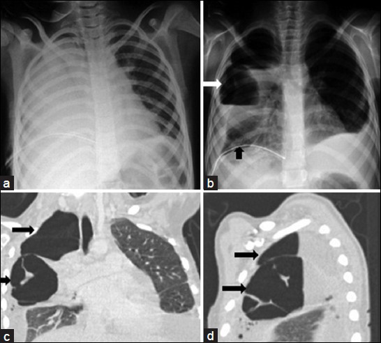 Lung abscess due to streptococcal pneumonia in a 15-year-old girl. a) Admission chest radiograph shows a complete opacification of a right hemithorax. b) Chest radiograph obtained 5 days after initial radiograph shows a large cavitary lesion (white arrows) with an air-fluid level within the right upper lobe opacification. Note the right parapneumonic effusion and chest tube drainage catheter (black arrow). c-d) Coronal and sagittal reformatted CT images of the chest reveal two cavitary lesions (black arrows) with an air-fluid level, and a septate and outer margin obscured by the surrounding pneumonia.