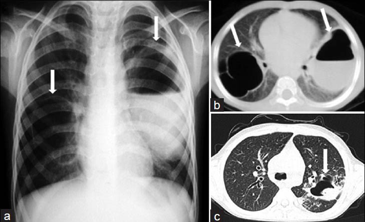 Complicated staphylococcal pneumonia associated with hyperimmunoglobulin E syndrome (Job's syndrome) in a 5-year old girl. a) Chest radiograph and b) CT scan show bilateral pneumatoceles with thin walls (white arrows) on the right and with air-fluid level on the left (white arrow). c) Follow-up CT scan obtained 4 years after the initial CT scan shows a fungus ball or mycetoma within the pneumatocele (white arrow) on the left. Diagnosis was confirmed at post-mortem examination.