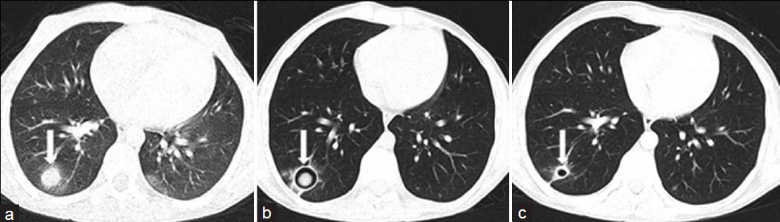 Invasive pulmonary aspergillosis in a 10-year-old boy with acute lymphoblastic leukemia. a) Active early lesion of invasive pulmonary aspergillosis with CT halo sign (white arrow). b) One year later, follow-up CT scan shows an intracavitary aspergilloma (white arrow) in the right lower lobe. c) Six months later, the lesion is healed. CT scan shows residual thin-walled cyst (white arrow).