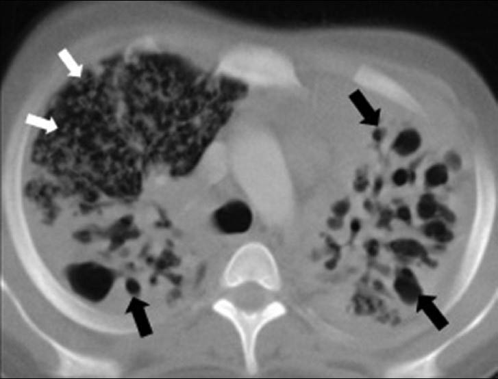 Destroid lung due to progressive pulmonary tuberculosis in a 16-year-old boy. CT scan (lung window) shows diffuse bilateral small and large air-filled cystic lesions (black arrows) associated with ground-glass attenuation and disseminated miliary micronodular lesions on the right (white arrows).