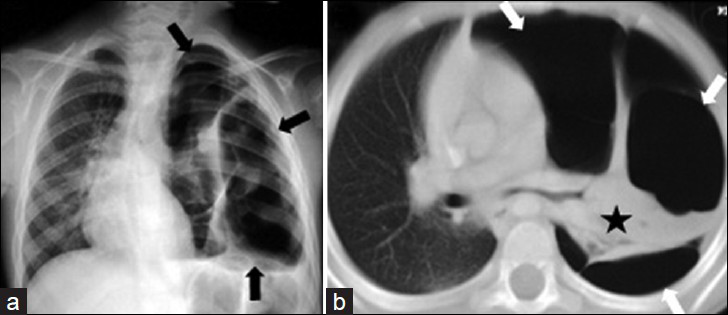 Destroid lung due to staphylococcal pneumonia in a 13-year-old girl with severe dyspnea and exertional syncope. a) Chest radiograph shows unilateral hyperlucency affecting the entire left lung (black arrows). b) CT scan (lung window) of the same children shows the loss of normal lung architecture and vascularity, necrosis areas that is replaced by multiple small and large air-filled pneumatoceles or thin-walled cavities on the left lung (white arrows), and shrinkage of the left lower lobe (asterisk). Note marked mediastinal shift to the right lung.