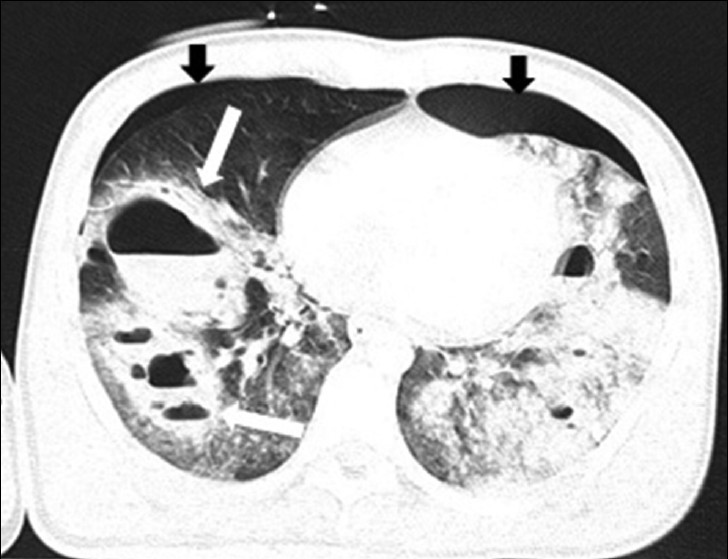 Traumatic pulmonary pseudocyst in a 15-year-old boy. CT scan shows multiple bilateral cystic lesions with air-fluid level (white arrows) on the right lung and patchy areas of ground-glass opacification. There are bilateral pneumothorax (black arrows).