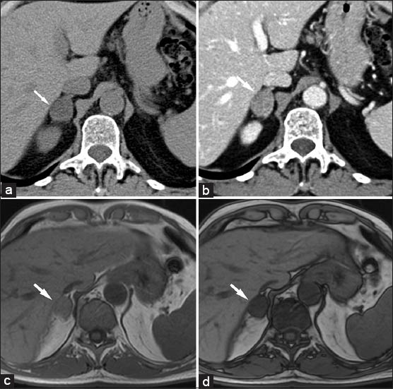 75-year-old male without history of malignancy with incidentally discovered adrenal adenoma. (a) Transverse nonenhanced computed tomography (CT) scan shows well-defined mass (arrow) with low attenuation to the liver parenchyma. (b) Dynamic contrast-enhanced CT scans obtained at the same level. Adenoma (arrow) exhibits rapid and homogeneous enhancement. (c) Corresponding transverse in-phase (160/4.9) and (d) Out-of-phase (160/2.5) T1-weighted gradient-echo magnetic resonance images show the, Lesion (arrow) with significant signal drop-off on out-of-phase magnetic resonance image due to the high lipid content which is diagnostic of adenoma.