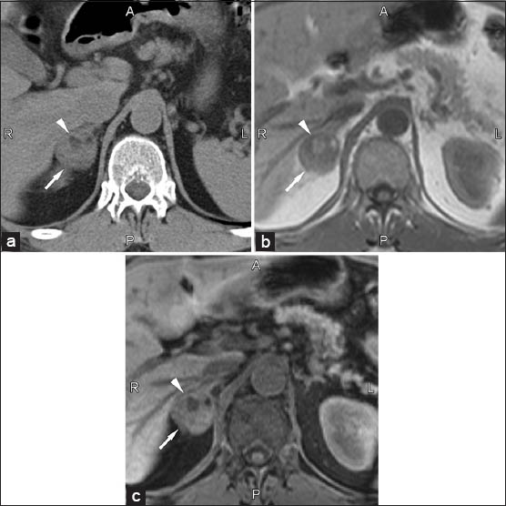 60-year-old male with incidentally discovered right adrenal myelolipoma. (a) Transverse non-enhanced computer tomography scan shows well-defined mass (arrow) with heterogeneous density due to the presence of focal areas of fat attenuation (arrowhead). (b and c) Corresponding transverse T1-weighted gradient-echo magnetic resonance images (160/4.9) (b) without and (c) with fat-suppression. The fatty component of the myelolipoma (arrowhead) shows a decrease of signal intensity on fat-suppressed image.