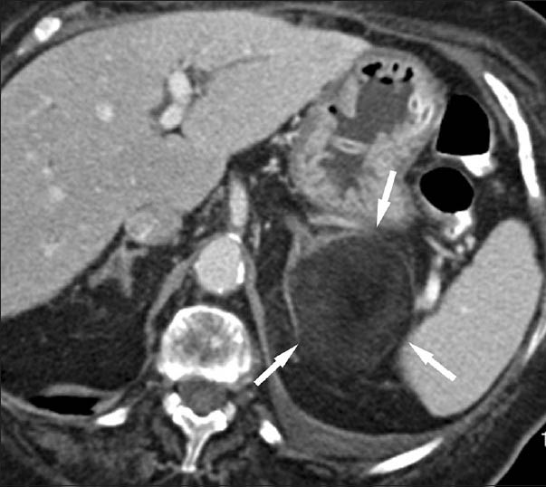 60-year-old male with atypical left adrenal myelolipoma simulating retroperitoneal liposarcoma. Transverse contrast-enhanced CT scan shows a large predominantly fat-containing lesion (arrows) originating from the medial and lateral arms of the gland.