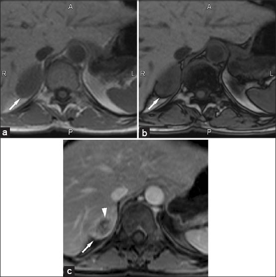 50-year-old female with lung cancer with typical right adrenal metastases. (a) Transverse in-phase (160/4.9) and (b) Out-of-phase (160/2.5) T1-weighted gradient-echo magnetic resonance images show the lesion (arrow) with no signal loss on out-of-phase images. (c) Transverse T1-weighted fat saturated contrast-enhanced magnetic resonance image (4.5/1.9) obtained at the same level show the lesion (arrow) has marked and heterogeneous enhancement due to a central area of necrosis (arrowhead).