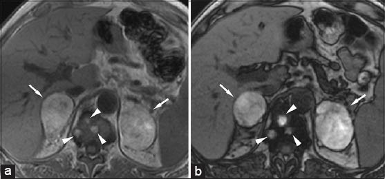 46-year-old male with melanoma presenting with adrenal insufficiency with bilateral adrenal metastases. (a) Transverse in-phase (160/4.9) and (b) outof-phase (160/2.5) T1-weighted gradient-echo magnetic resonance images-due to the high content of melanin, the lesion (arrow) shows high signal intensity on in-phase image that may simulate a high lipid content mass. However, no signal loss is observed on out-of-phase image. Note multiple metastases into the vertebral body (arrowheads).