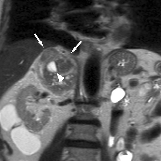 85-year-old male with abdominal pain diagnosed with right adrenal carcinoma. Coronal contrast-enhanced computed tomography scan shows a large, lobulated, right upper quadrant mass with heterogeneous enhancement (arrows) and nonspecific central areas of necrosis (arrowhead).