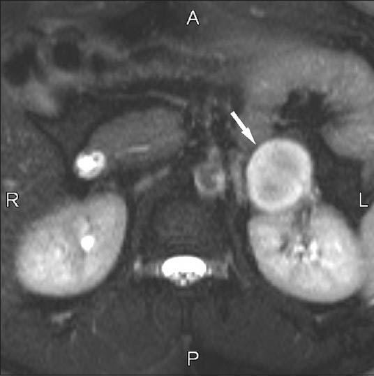 55-year-old male with hypertension with left adrenal pheochromocytoma. Transverse fat-saturated T2-weighted half-Fourier acquisition single-shot turbo spin-echo sequence (∞/90) shows a markedly hyperintense well defined lesion (arrow).