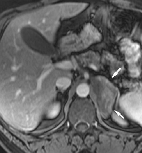 43-year-old male with left adrenal lymphoma. Transverse in-phase (4.5/1.9) T1-weighted gradient-echo magnetic resonance image with fat suppression shows a large left adrenal lesion (arrow) with mild and heterogeneous enhancement. Differential diagnosis with adrenal metastases may not be possible with imaging findings.