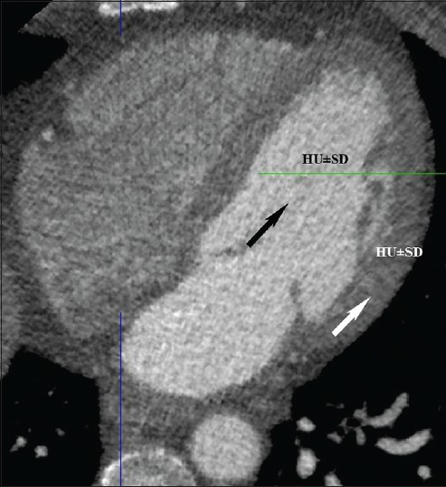 55-year-old-male with chest pain. Normal axial computed tomography shows region of interest in left ventricular chamber (black arrow) and left ventricular wall (white arrow) for image noise, signal to noise ratio and contrast to noise ratio.
