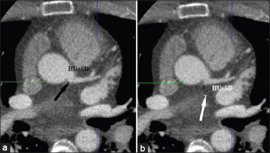 (a) 64-year-old-female with dyspnea. Normal axial computed tomography shows region of interest at the origin of left main artery (black arrow) to determine image noise, signal to noise ratio and contrast to noise ratio. (b) 52-year-old-male with chest pain. Normal axial computed tomography reveals region of interest at the perivascular area (white arrow) to determine image noise, signal to noise ratio and contrast to noise ratio.