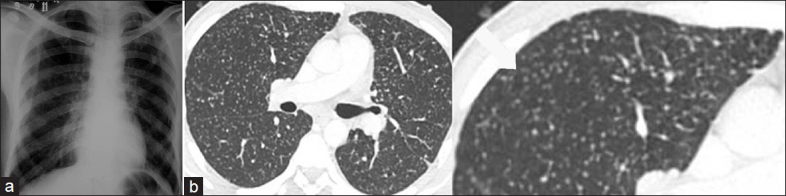 54-year-old man working as stone cutter for 25 years with simple silicosis on HRCT and normal chest radiograph. (a) Radiograph of chest in posteroanterior view shows no abnormality. (b) HRCT thorax in axial plane: Multiple small well defined nodules, round opacities (RO type P) (arrows) seen in bilateral upper lobes.