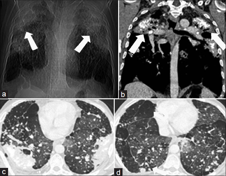 61-year-old man construction worker with silicosis and progressive massive fibrosis. (a) Computed tomography topogram shows large bilateral opacities in the upper zones of the lung with large emphysematous bullae in lower lobes. (b) Coronal CT scan obtained with mediastinal window settings shows bilateral conglomerate masses with calcifications (arrows). (c and d) Axial HRCT images in lung window, show presence of round opacities (RO) with paraseptal emphysema (EM) in addition.