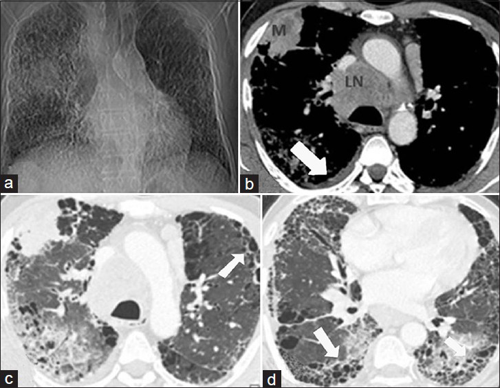 71-year-old man with asbestos related lung disease and bronchogenic carcinoma. (a) CT topogram shows presence of reticular opacities in bilateral lung parenchyma with an ill-defined mass in right upper zone. (b) Axial contrast enhanced CT demonstrates presence of a malignant mass (M) with mediastinal lymphadenopathy (LN) and right pleural effusion (arrow). (c and d) Axial HRCT images in lung window show evidence of intralobular septal thickening with honeycombing (arrows), findings consistent with advanced asbestosis.