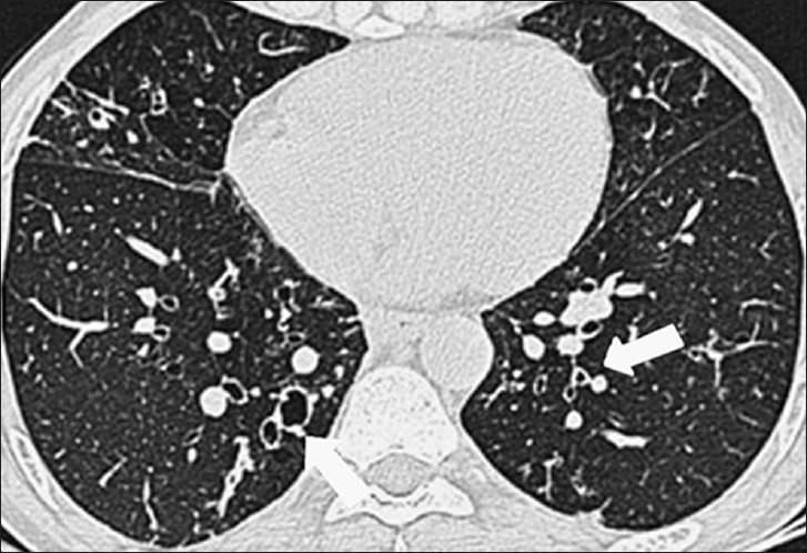 38-year-old woman with plastic fumes exposure. Axial HRCT image in lung window shows presence of minimal central cylindrical bronchiectasis (BE) with bronchial wall thickening (BR) (arrows). Patient demonstrated obstructive pattern of abnormality on spirometry.