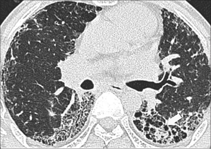 50-year-old man with exposure to aluminum dust for 30 years. Axial HRCT image in lung window shows interlobular and intralobular septal thickening and honeycombing in upper lobes.