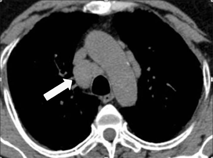 45-year-old woman working in dental prostheses manufacturing unit with chronic berylliosis. Axial CT image in mediastinal window demonstrate mediastinal lymphadenopathy (arrow).