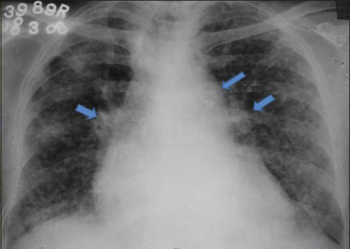 45-year-old man working in glass industry diagnosed with silicosis. (a) Radiograph of chest in posteroanterior projection shows multiple nodules in bilateral lung parenchyma with calcified mediastinal and hilar lymphnodes (arrows). These findings in association with appropriate history of exposure are diagnostic of silicosis.