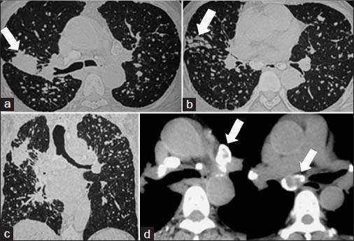 HRCT thorax of the same patient. (a and b) Axial and (c) coronal images in lung window: Multiple round opacities (RO type P) seen in bilateral lung parenchyma with upper zone predominance. There is evidence of confluence (AX) (arrow in b) and a large opacity (arrow in a) seen in posterior segment of right upper lobe. (d) Axial image in mediastinal window show calcified hilar and mediastinal lymphnodes with egg-shell calcification (arrows).