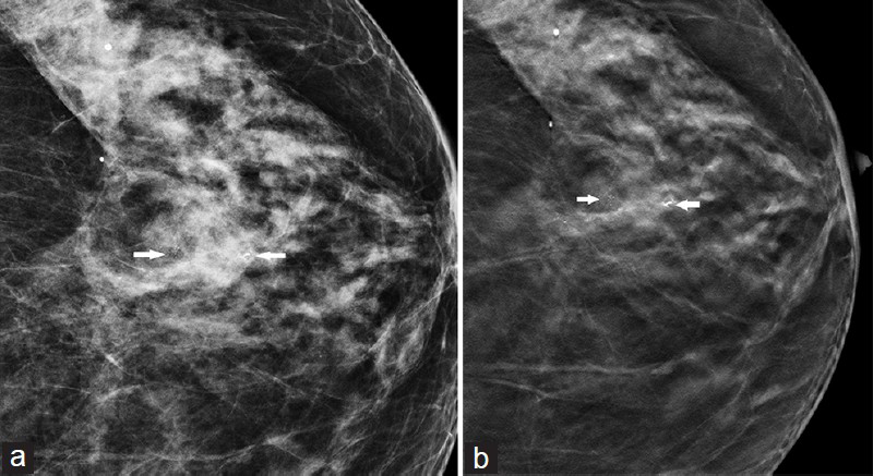 (a) Craniocaudal full field digital mammogram zoomed in shows calcifications diagnosed as ductal carcinoma in situ (arrows). (b) Zoomed craniocaudal three-dimensional (3D) digital tomosynthesis shows reconstructed slice.