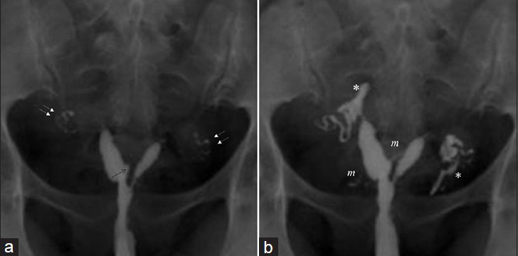 (a and b) 36-year-old women with communicating unicornuate uterus (American Fertility Society (AFS) IIa. Images show Mild (Level 1) intravasation endometrial bulging (arrow), myometrial enhancement (m), patent tubes (double arrows), and minimal peritoneal spillage (*).